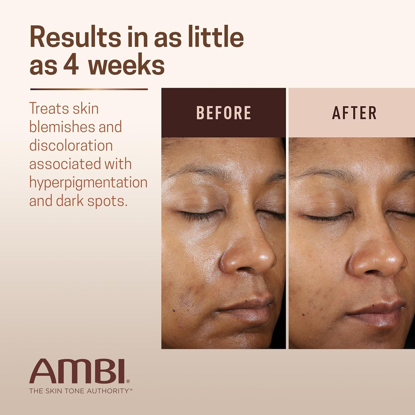 Ambi Even & Clear Advanced Fade Cream, Hydroquinone-free, Hyperpigmentation Treatment, Stubborn Dark Spot Corrector, Niacinamide, Licorice Root Extract, PHA, 1 Fl Oz